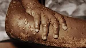 Frontline Medical Staff in Eastern DRC Plead for Mpox Vaccines Amidst Rising Cases